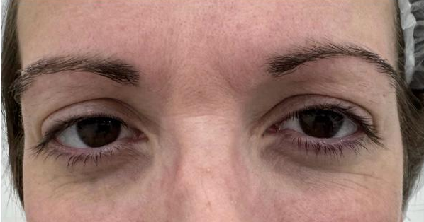 Blefaroplastia 2 - Antes