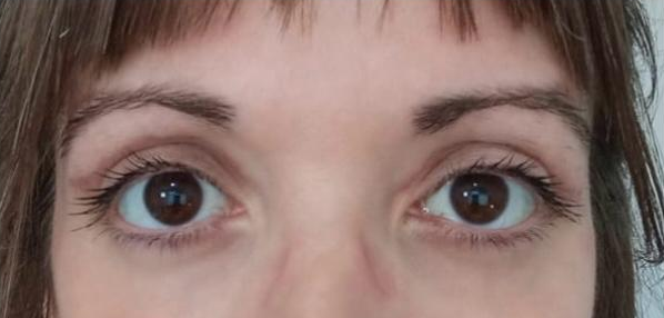 Blefaroplastia 2 - Después