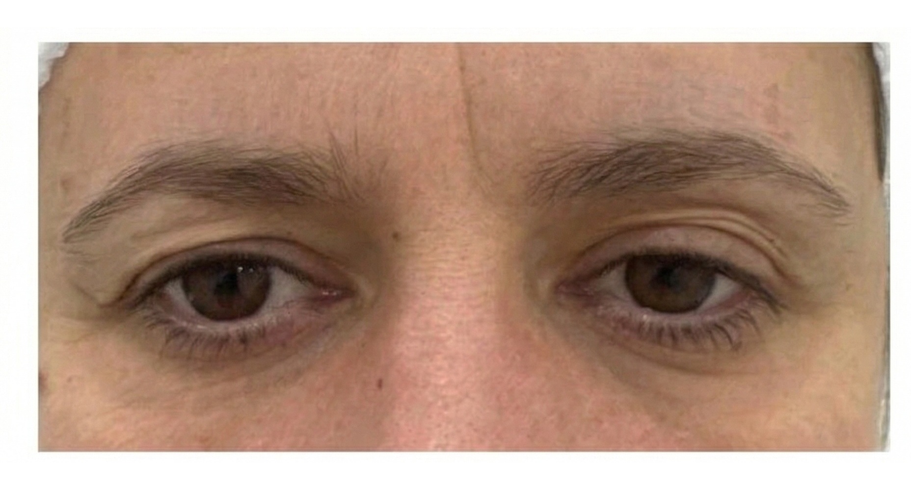 Blefaroplastia 3 - Antes