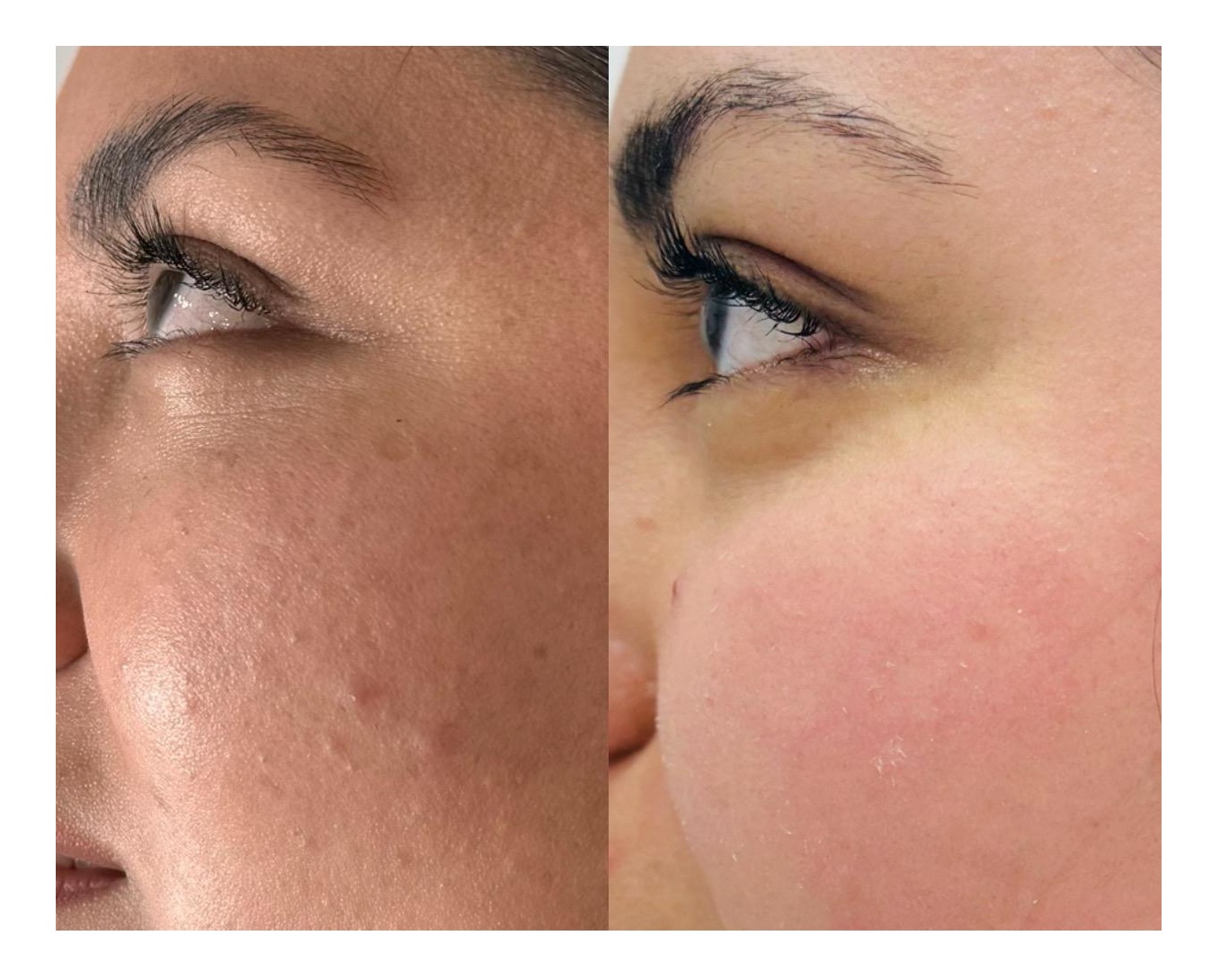 Caso 2: Antes y Después del tratamiento con CO2