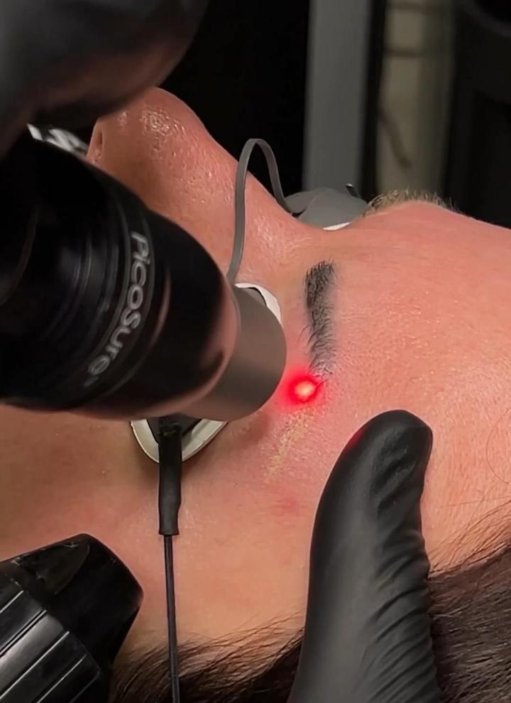 Tratamiento Picosegundo - Caso 1