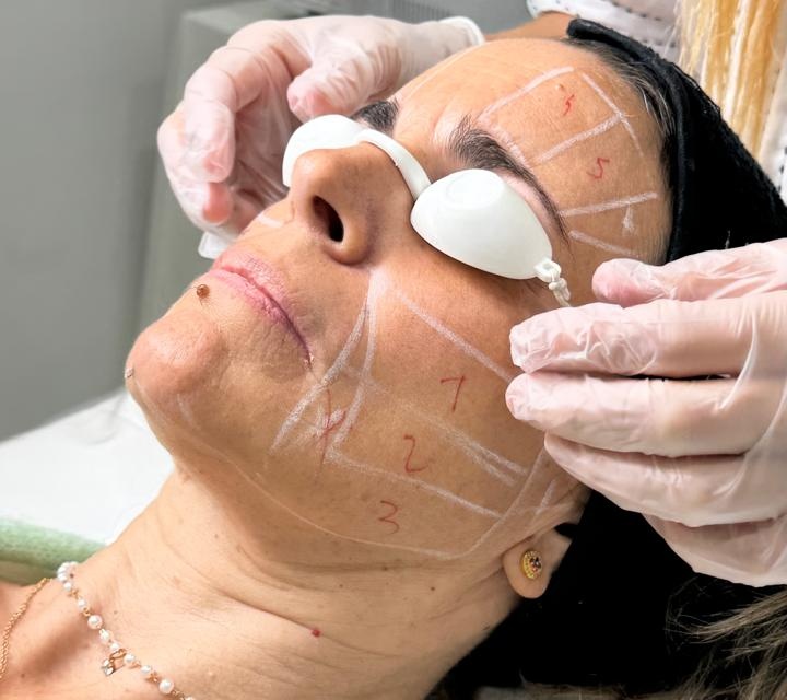 Ultherapy procedure 2